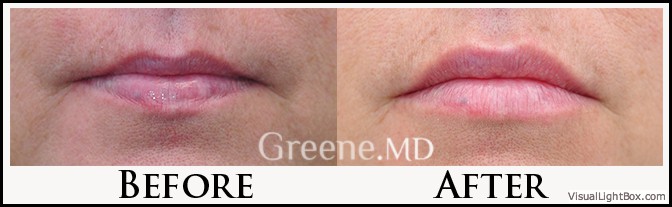 Lip Filler Case 96 Combined Image