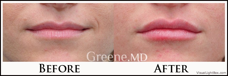 Lip Filler Case 78 Combined Image