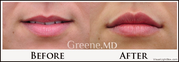 Lip Filler Case 35 Combined Image