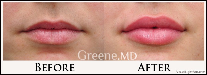 Lip Filler Case 30 Combined Image