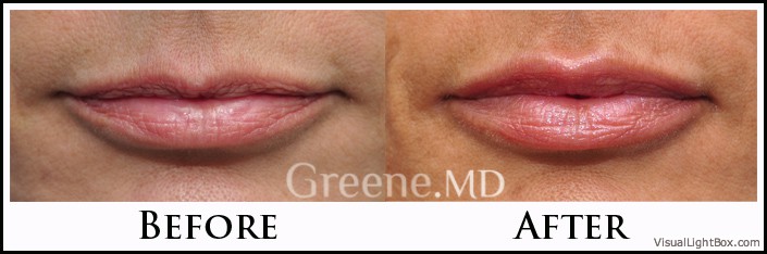 Lip Filler Case 50 Combined Image