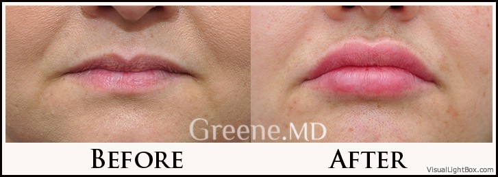 Lip Filler Case 72 Combined Image