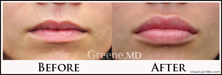 Lip Filler Case 2 Combined Image