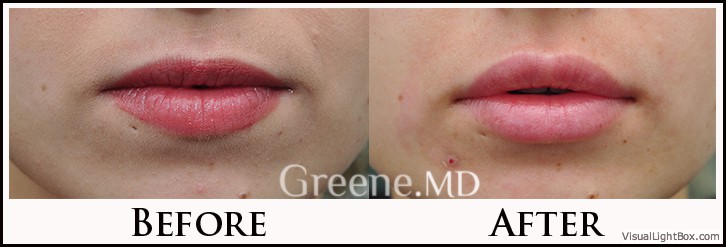 Lip Filler Case 31 Combined Image