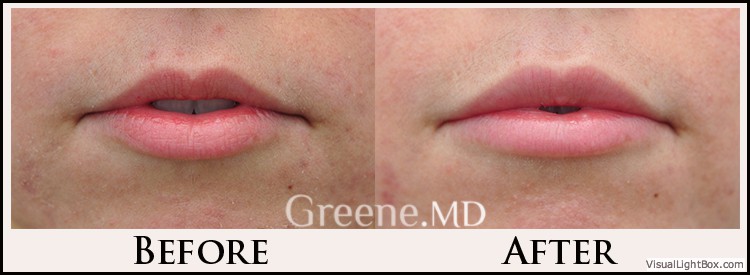 Lip Filler Case 79 Combined Image