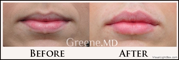 Lip Filler Case 7 Combined Image