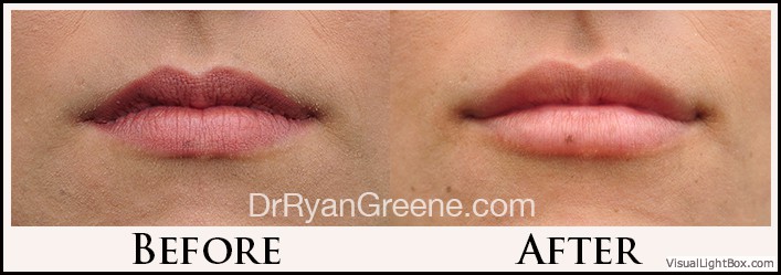 Lip Filler Case 20 Combined Image