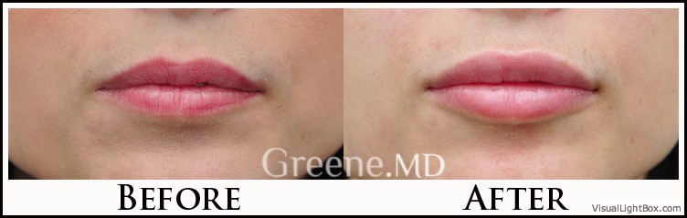 Lip Filler Case 8 Combined Image