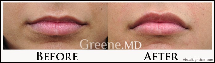 Lip Filler Case 69 Combined Image