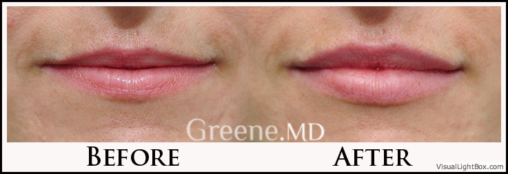 Lip Filler Case 59 Combined Image