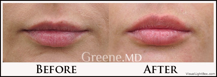 Lip Filler Case 28 Combined Image