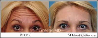 Botox and Dysport Case 6 Combined Image