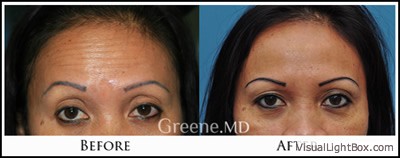 Botox and Dysport Case 7 Combined Image