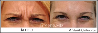 Botox and Dysport Case 8 Combined Image