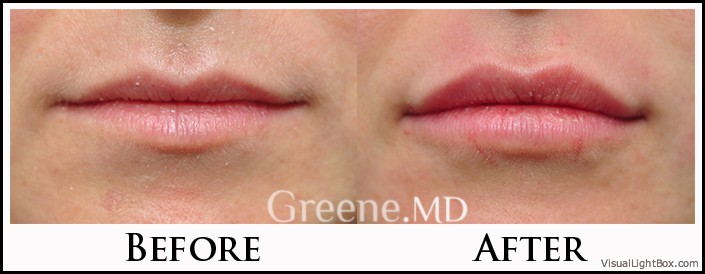 Lip Filler Case 60 Combined Image