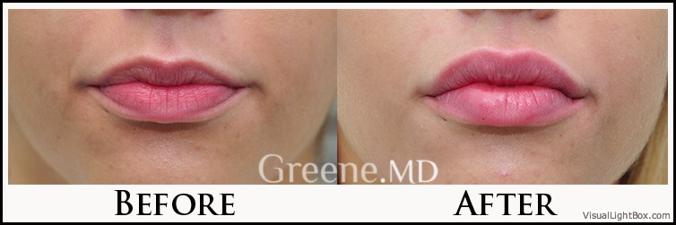 Lip Filler Case 43 Combined Image