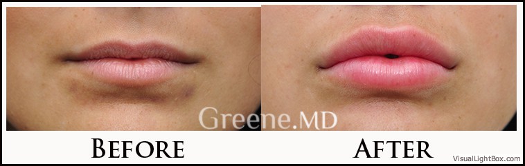 Lip Filler Case 9 Combined Image