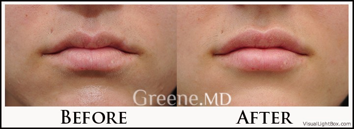 Lip Filler Case 85 Combined Image