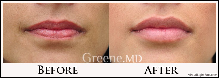 Lip Filler Case 4 Combined Image