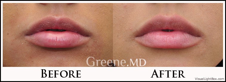 Lip Filler Case 75 Combined Image