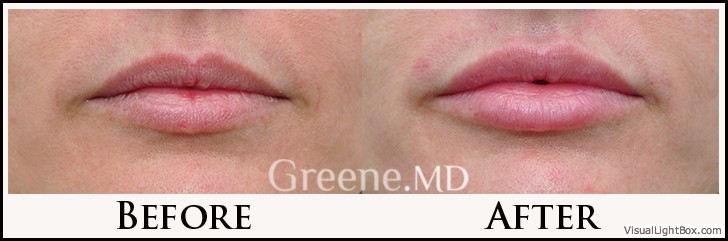 Lip Filler Case 82 Combined Image