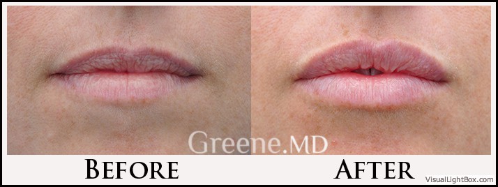 Lip Filler Case 84 Combined Image