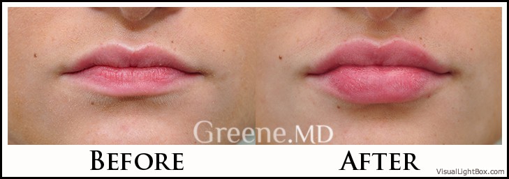 Lip Filler Case 70 Combined Image