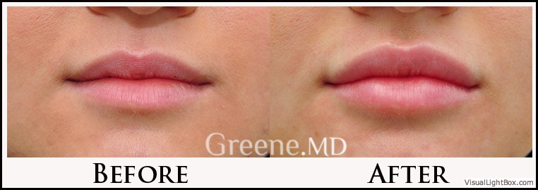 Lip Filler Case 3 Combined Image