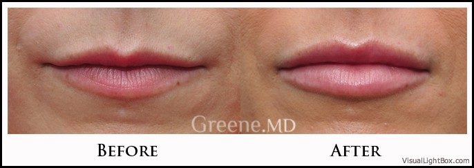 Lip Filler Case 38 Combined Image
