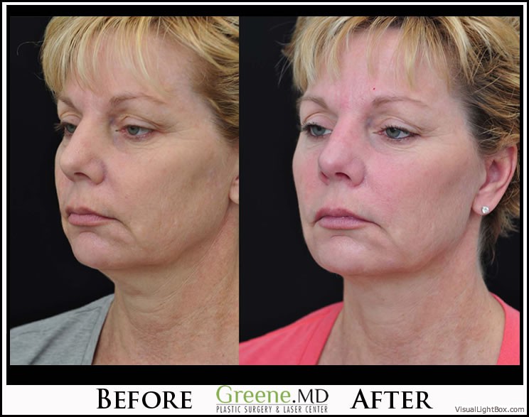 Ultherapy Case 4 Combined Image