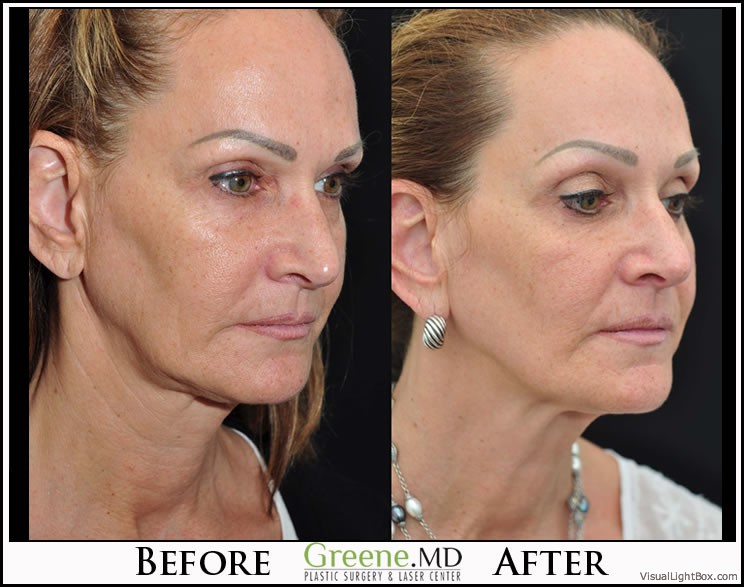 Ultherapy Case 7 Combined Image