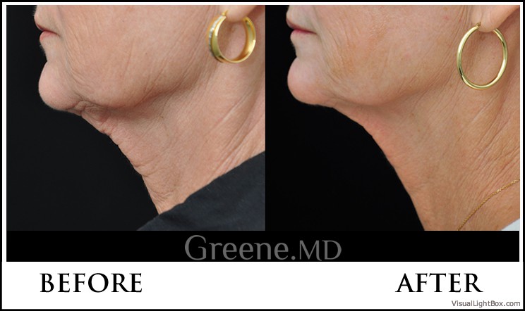 Ultherapy Case 11 Combined Image