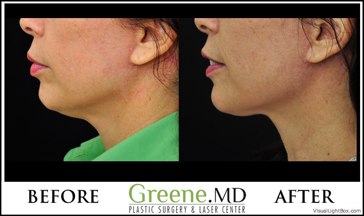 Ultherapy Case 2 Combined Image
