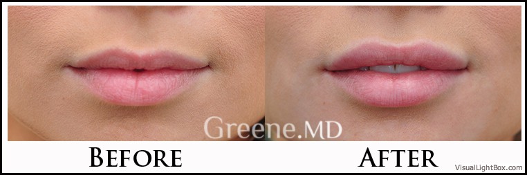 Lip Filler Case 6 Combined Image