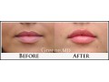 Lip Filler Case 86 Combined Image