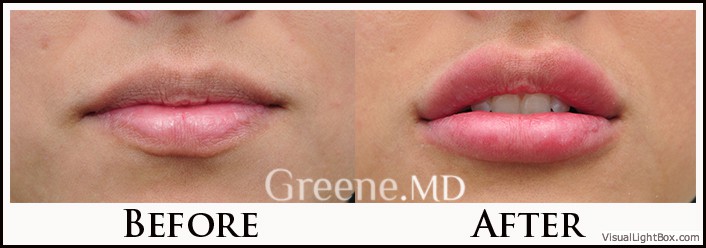Lip Filler Case 87 Combined Image