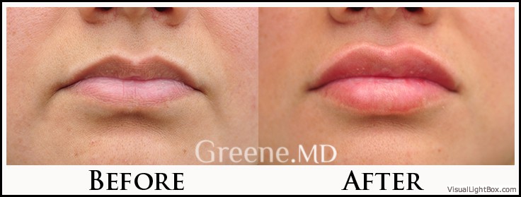 Lip Filler Case 5 Combined Image