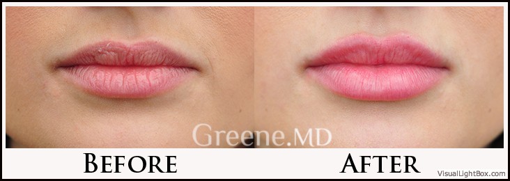 Lip Filler Case 29 Combined Image