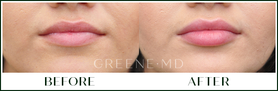 Lip Filler Case 117 Combined Image