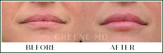 Lip Filler Case 118 Combined Image