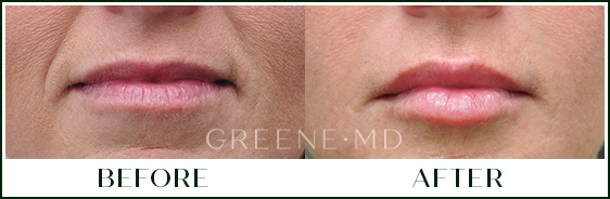 Lip Filler Case 119 Combined Image